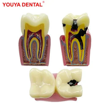 Модел на зъбите Модел на кариес Голяма анатомическая модел на зъбите Модел на зъбния кариес за обучение на Демонстрационно общуването с пациента